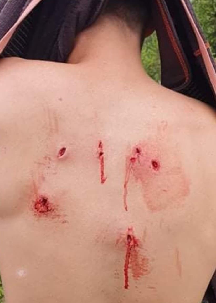 Två bilder: Man som visar bar rygg med blodiga sår från björnattack.
Ung man i sjukhussäng med blått munskydd och vita sjukhuskläder, håller en tumme upp.