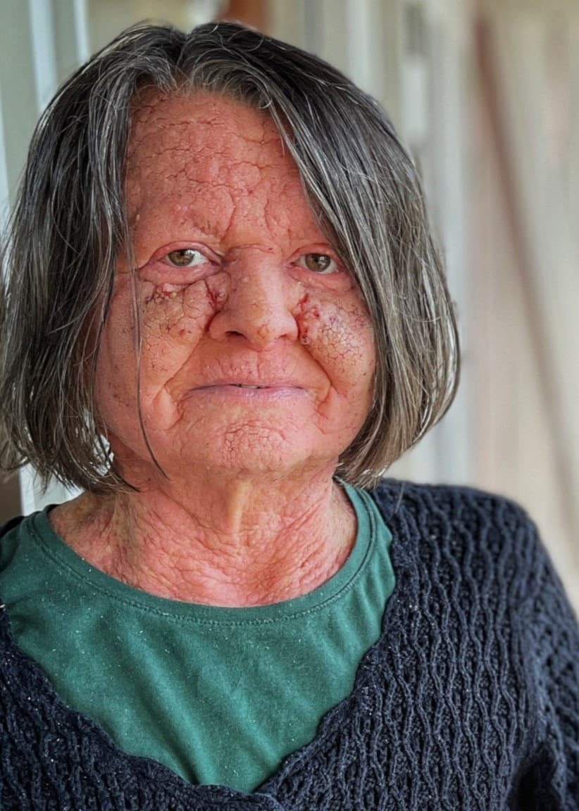 Laila Eriksson, klädd i en stickad tröja, står vid en röd vägg och berättar om sina erfarenheter av att hantera en hudsjukdom och bristfällig hjälp från regionen.